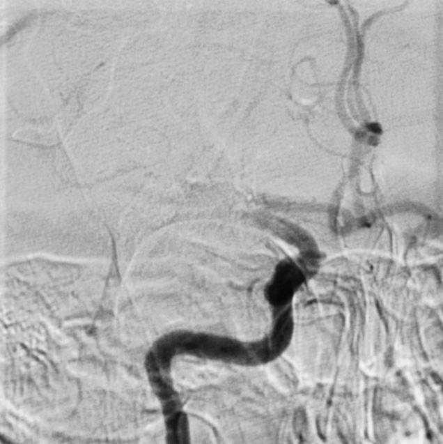 ET procedure: A tiny tube was put in through the groin and advanced to the vessels in the neck using X-ray guidance. Injection of contrast shows where the vessel is blocked off.